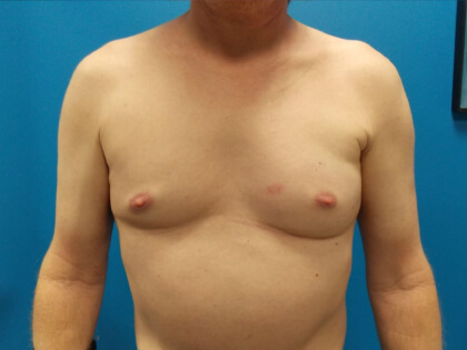 Poland Syndrome Before & After Patient #3166