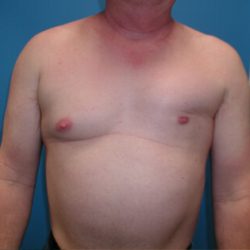 Poland Syndrome Before & After Patient #3166