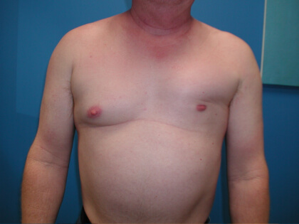 Poland Syndrome Before & After Patient #3166