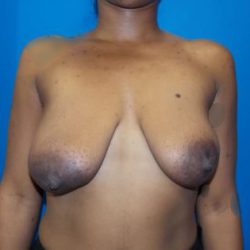 Direct to Implant Breast Reconstruction Before & After Patient #3247