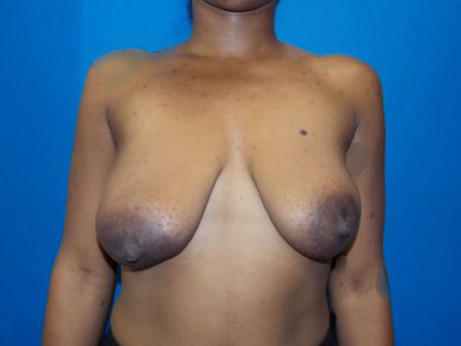 Direct to Implant Breast Reconstruction Before & After Patient #3247