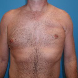 Poland Syndrome Before & After Patient #3202