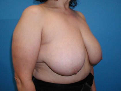 Breast Reduction Before & After Patient #3240