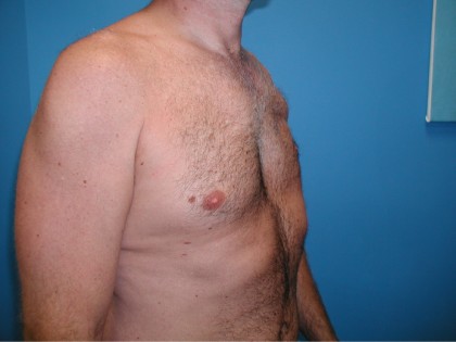 Poland Syndrome Before & After Patient #3202