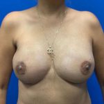 Direct to Implant Breast Reconstruction Before & After Patient #3223