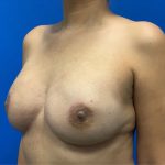 Direct to Implant Breast Reconstruction Before & After Patient #3223