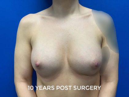 Breast Augmentation Before & After Patient #3146