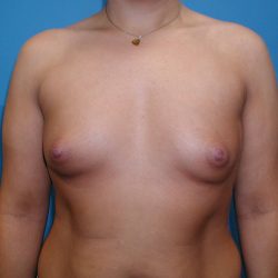 Breast Augmentation Before & After Patient #3146
