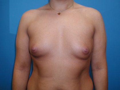 Breast Augmentation Before & After Patient #3146