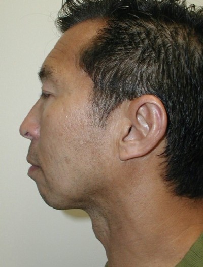 Chin Implant Before & After Patient #3206