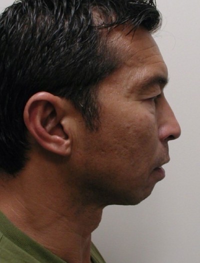Chin Implant Before & After Patient #3206