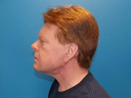 Face & Neck Lift Before & After Patient #3232