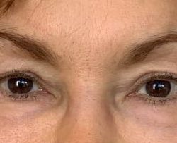 Upper Blepharoplasty Before & After Patient #3400
