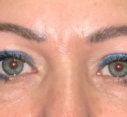 Quad Blepharoplasty Before & After Patient #3361