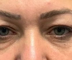 Quad Blepharoplasty Before & After Patient #3361