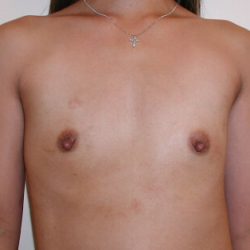 Breast Augmentation Before & After Patient #3386