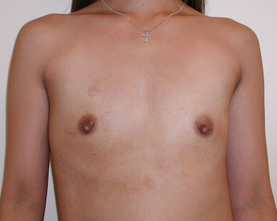 Breast Augmentation Before & After Patient #3386