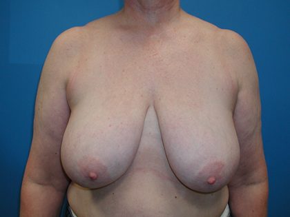 Breast Reduction Before & After Patient #3316