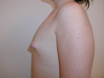 Breast Augmentation Before & After Patient #3479
