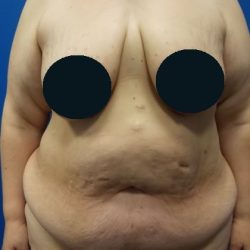 Tummy Tuck Before & After Patient #3464