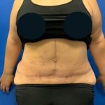 Tummy Tuck Before & After Patient #3464