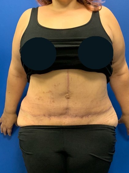 Tummy Tuck Before & After Patient #3464