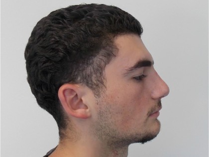 Rhinoplasty Before & After Patient #3444