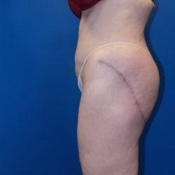 Body Contouring Before & After Patient #3536