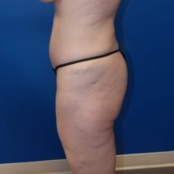 Body Contouring Before & After Patient #3536