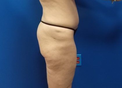 Body Contouring Before & After Patient #3536