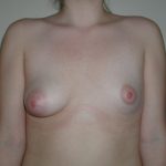 Breast Asymmetry Correction Before & After Patient #3599