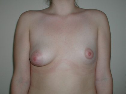 Breast Asymmetry Correction Before & After Patient #3599