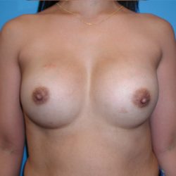 Breast Augmentation Before & After Patient #3386