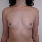 Breast Augmentation Before & After Patient #3606