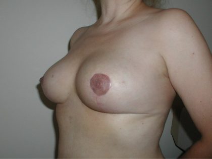 Breast Lift Before & After Patient #3592