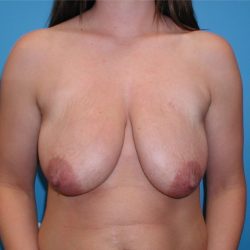Breast Lift & Augmentation Before & After Patient #3585