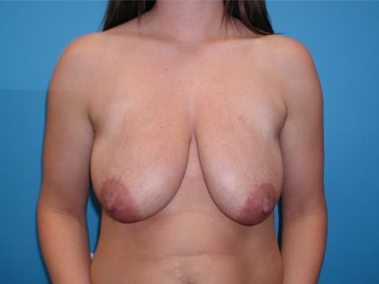 Breast Lift & Augmentation Before & After Patient #3585