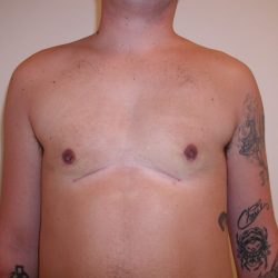 Gynecomastia Before & After Patient #3295
