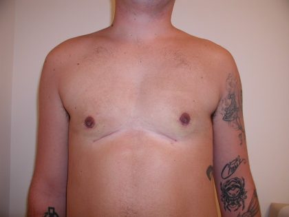 Gynecomastia Before & After Patient #3295