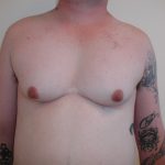 Gynecomastia Before & After Patient #3295