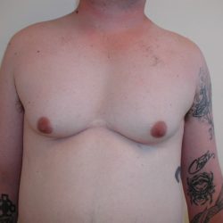 Gynecomastia Before & After Patient #3295