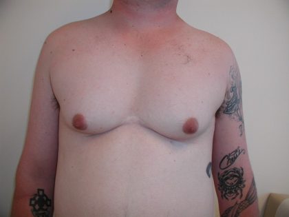 Gynecomastia Before & After Patient #3295