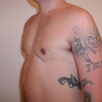 Gynecomastia Before & After Patient #3295
