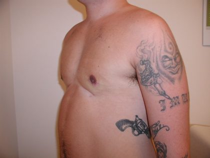 Gynecomastia Before & After Patient #3295