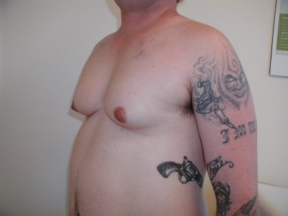 Gynecomastia Before & After Patient #3295