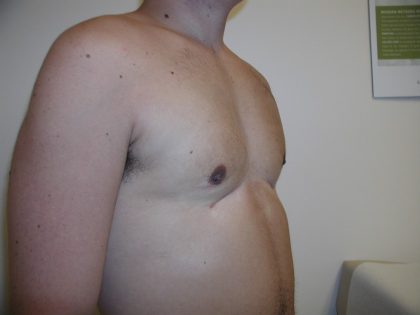 Gynecomastia Before & After Patient #3295