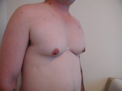 Gynecomastia Before & After Patient #3295