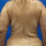 Local Flap Breast Reconstruction Before & After Patient #3427