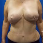 Local Flap Breast Reconstruction Before & After Patient #3427