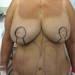 Local Flap Breast Reconstruction Before & After Patient #3427